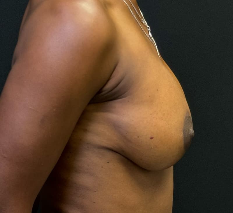 Breast Augmentation After - Patient 278457 - Right View