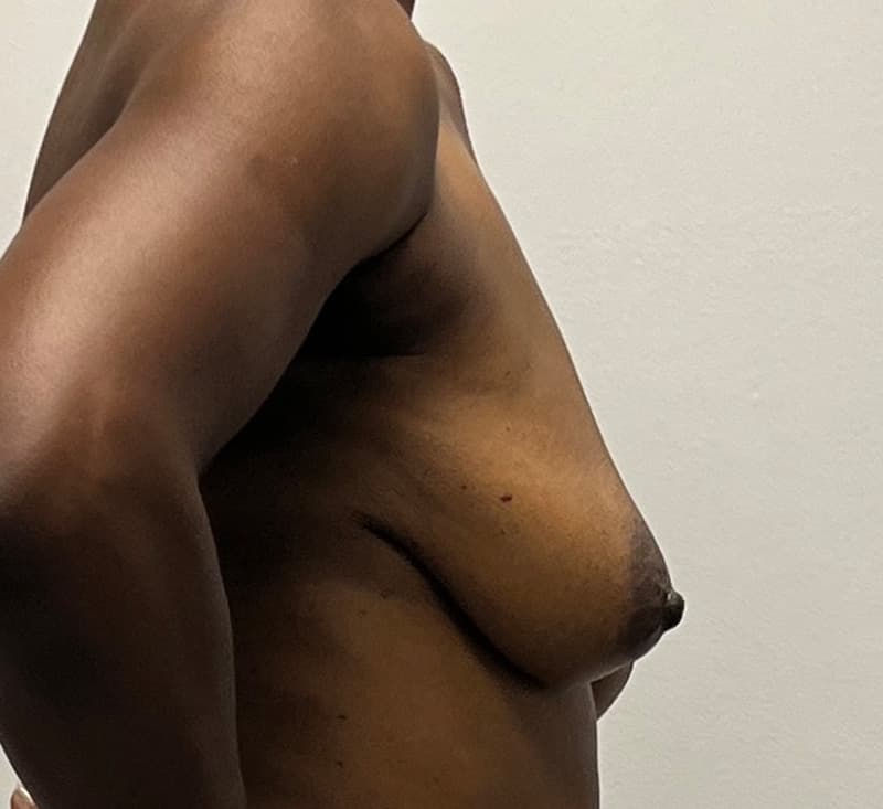 Breast Augmentation Before - Patient 278457 - Right View