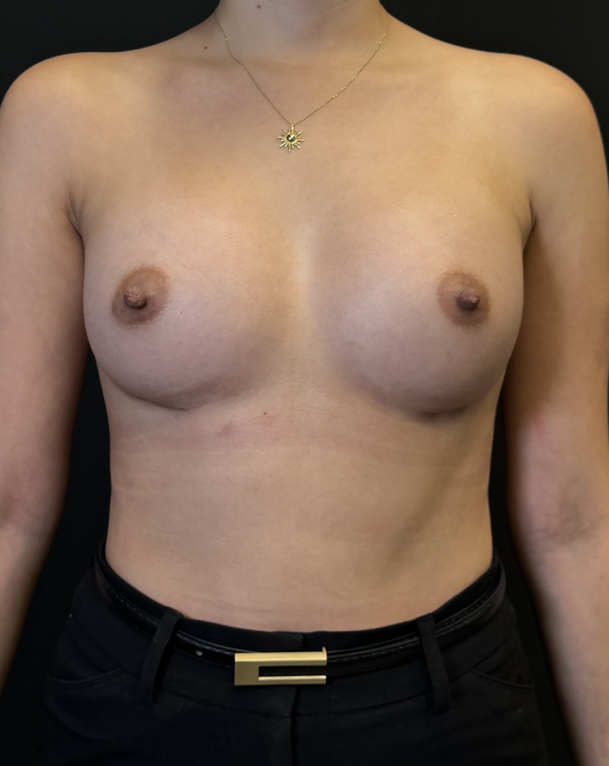 Breast Augmentation After - Patient 4188 - Front View