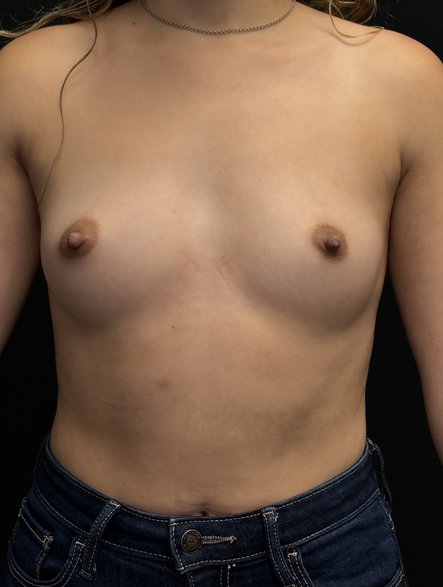 Breast Augmentation Before - Patient 4188 - Front View