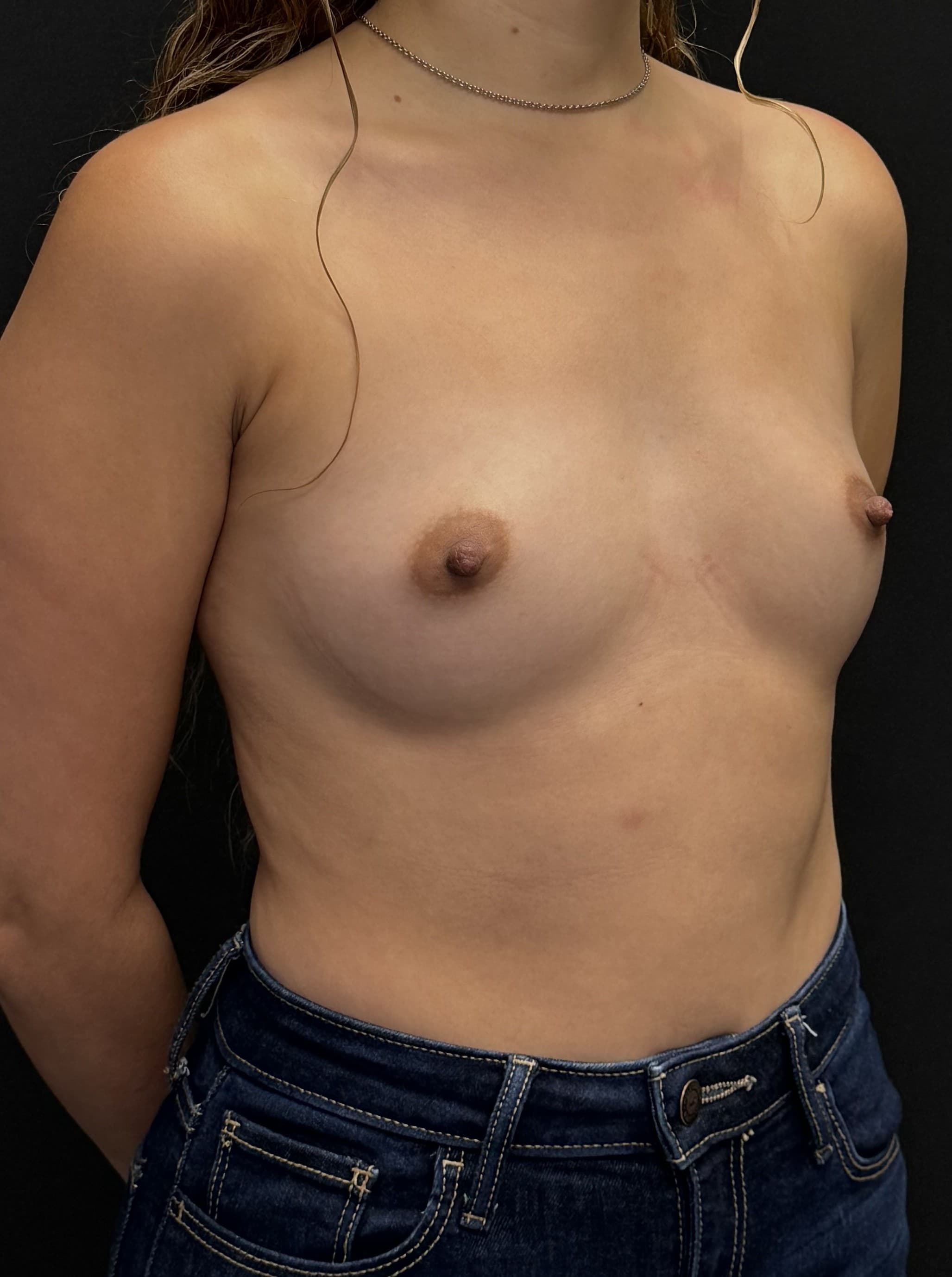 Breast Augmentation Before - Patient 4188 - Front Right View