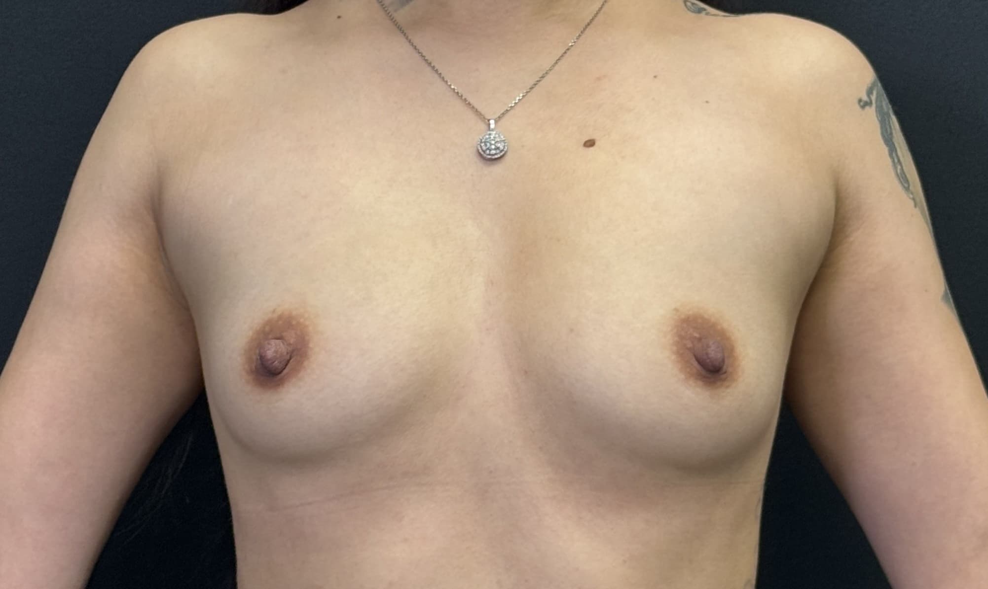 Breast Augmentation Before - Patient 4817 - Front View