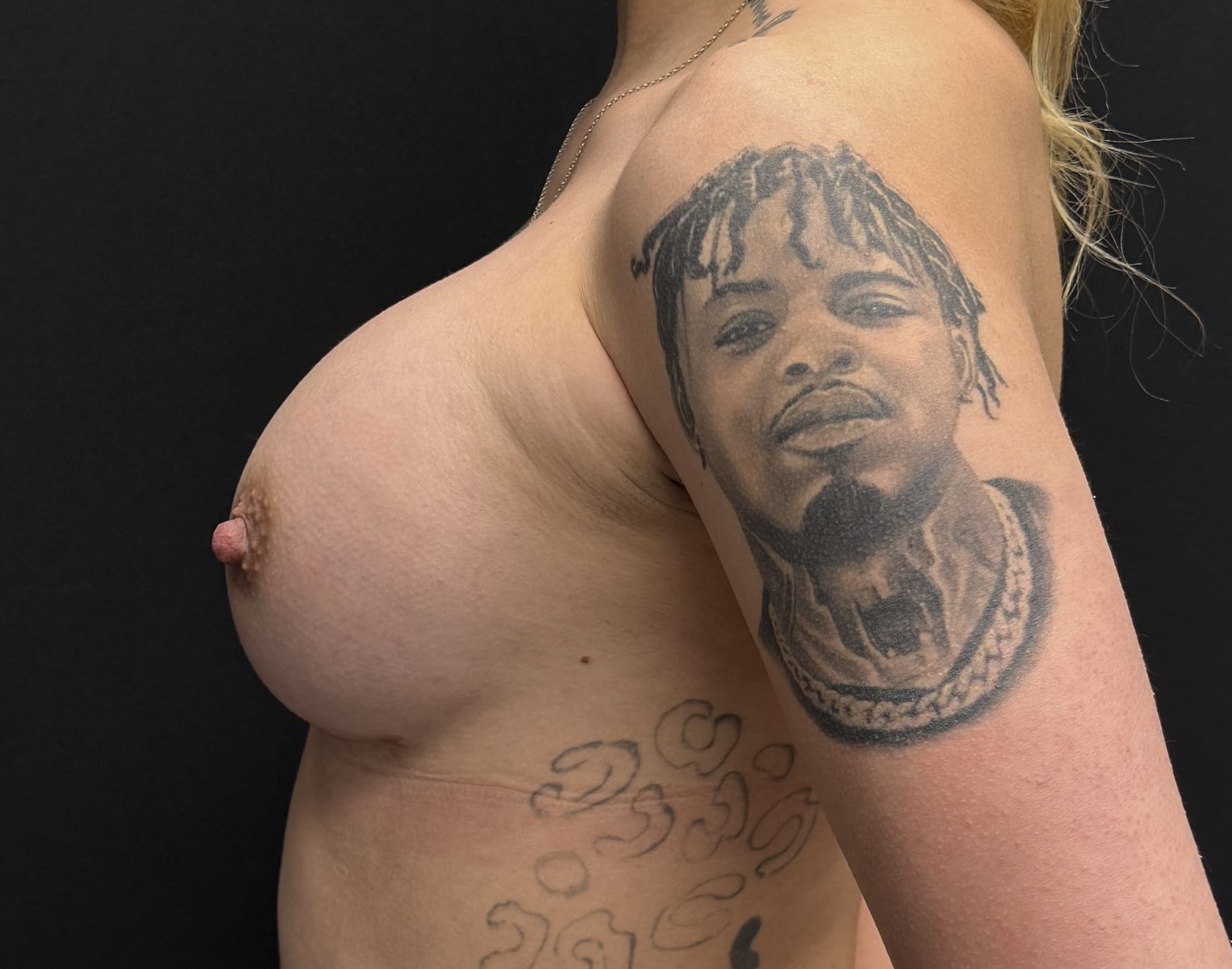 Breast Augmentation After - Patient 4817 - Left View