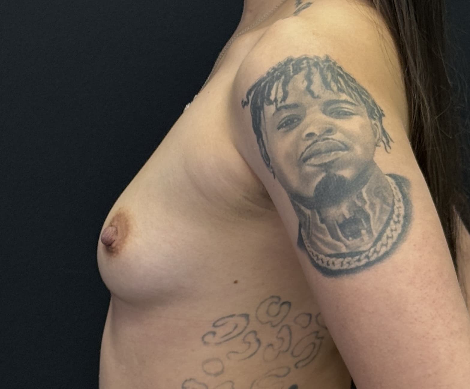 Breast Augmentation Before - Patient 4817 - Left View