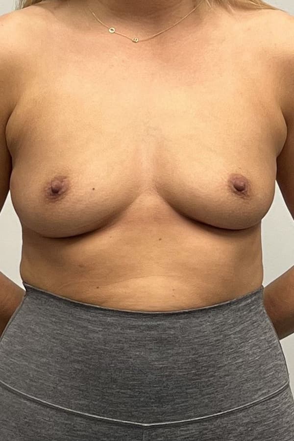 Breast Augmentation Before - Patient 494011 - Front View
