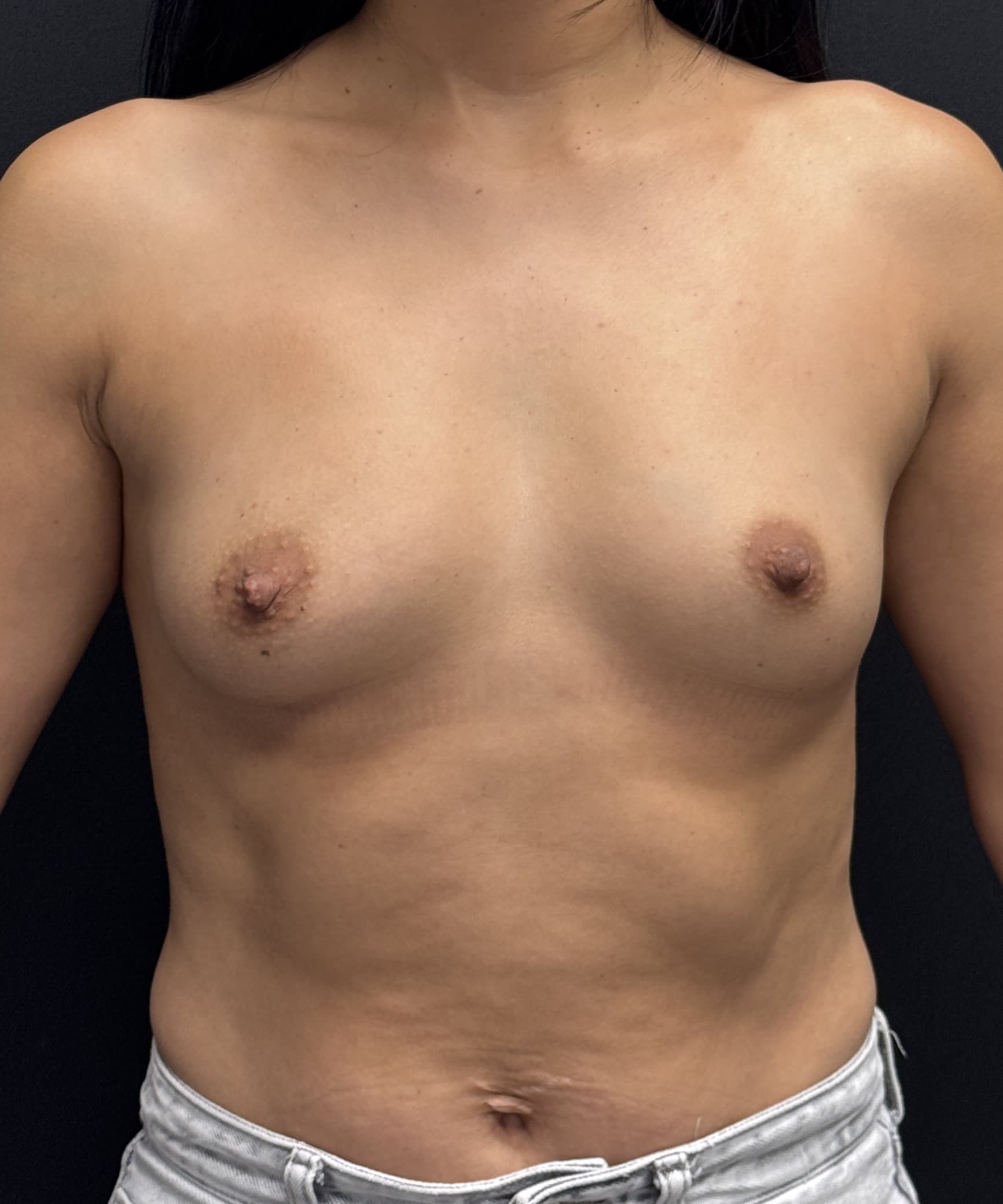 Breast Augmentation Before - Patient 4944 - Front View