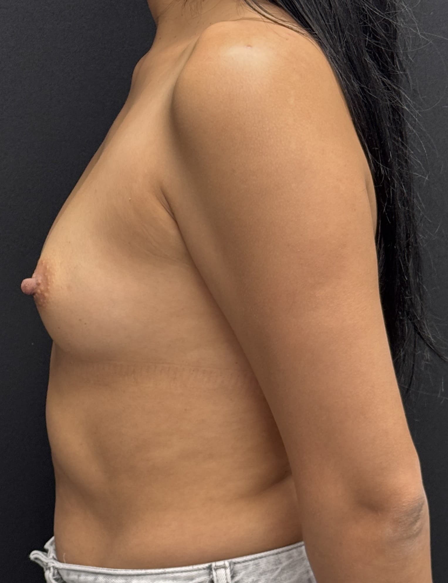 Breast Augmentation Before - Patient 4944 - Left View