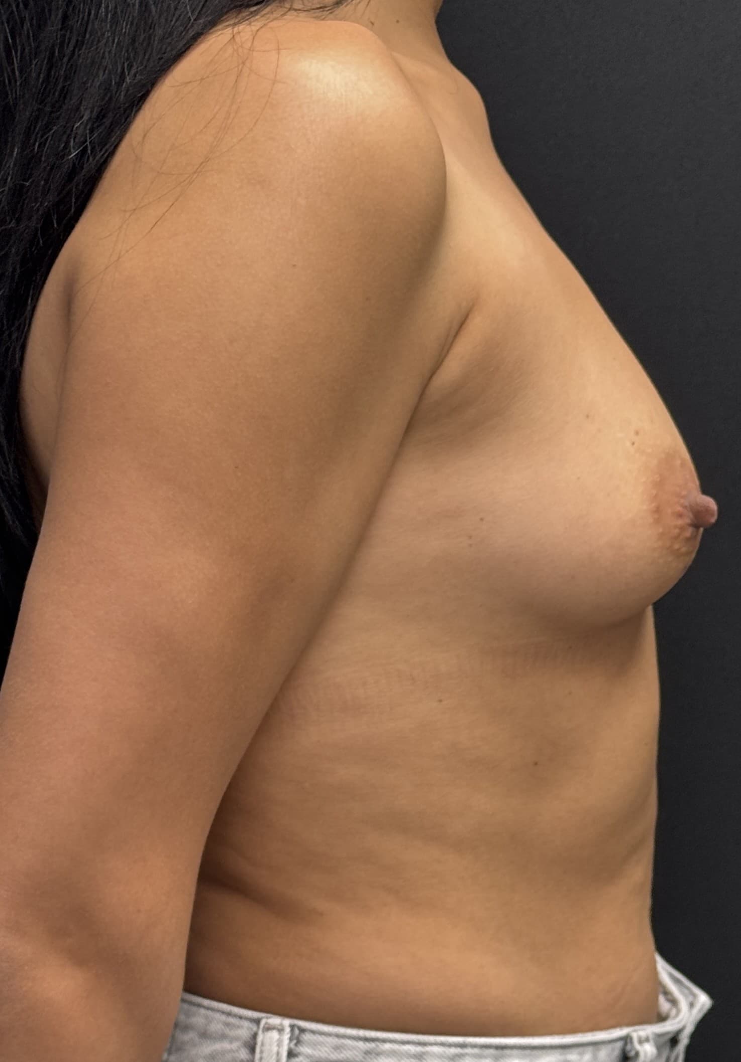 Breast Augmentation Before - Patient 4944 - Right View