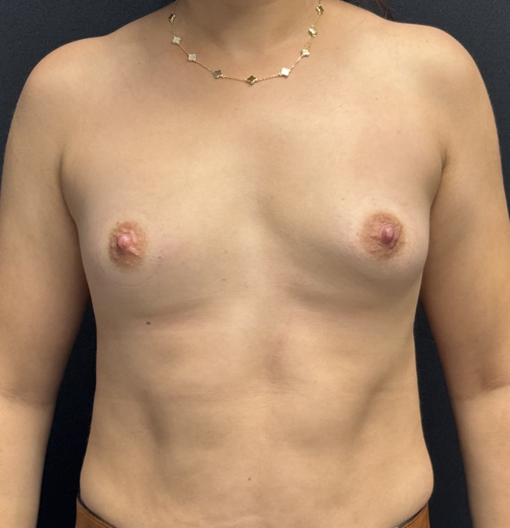 Breast Augmentation Before - Patient 5427 - Front View
