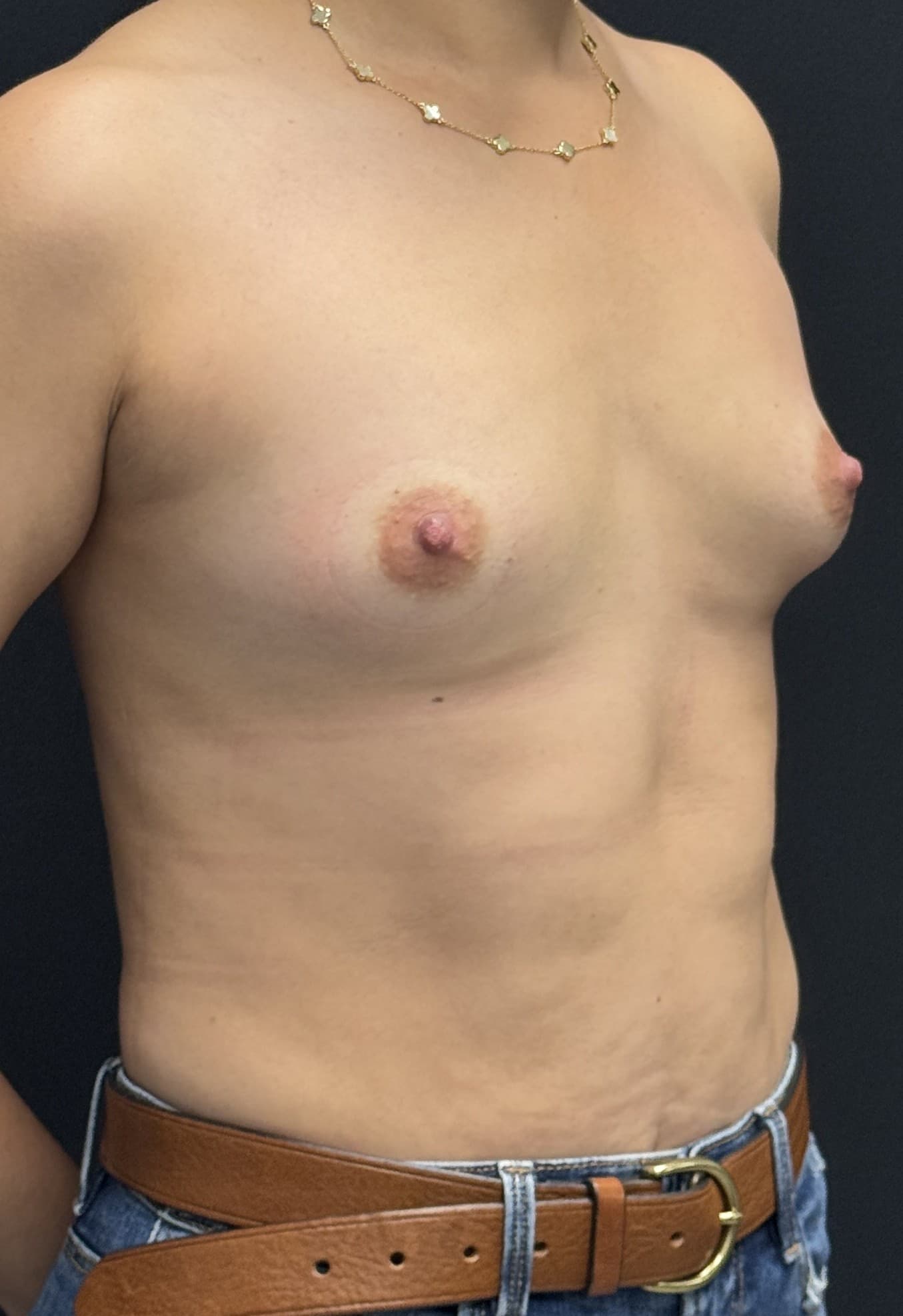 Breast Augmentation Before - Patient 5427 - Front Right View