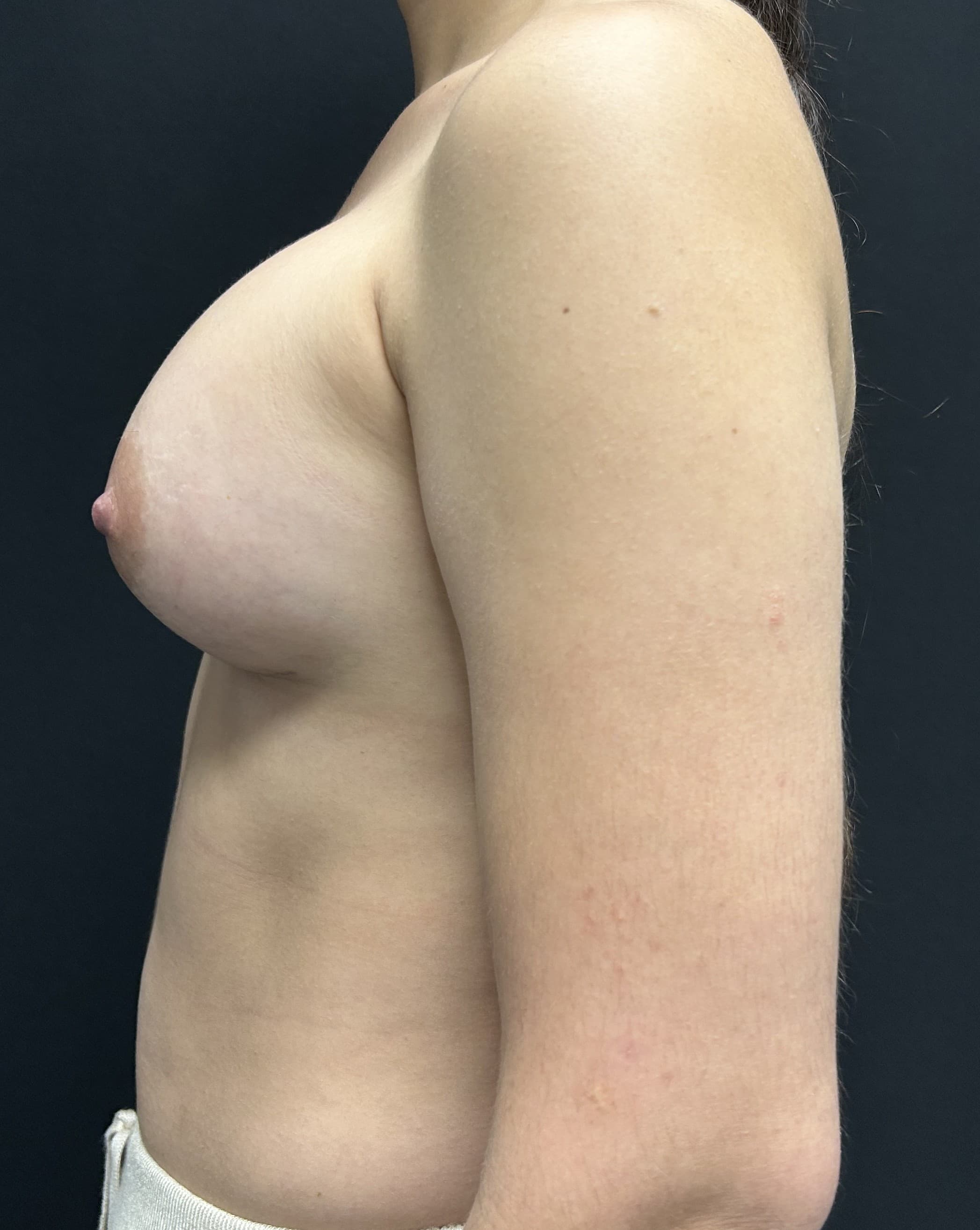 Breast Augmentation After - Patient 5427 - Left View