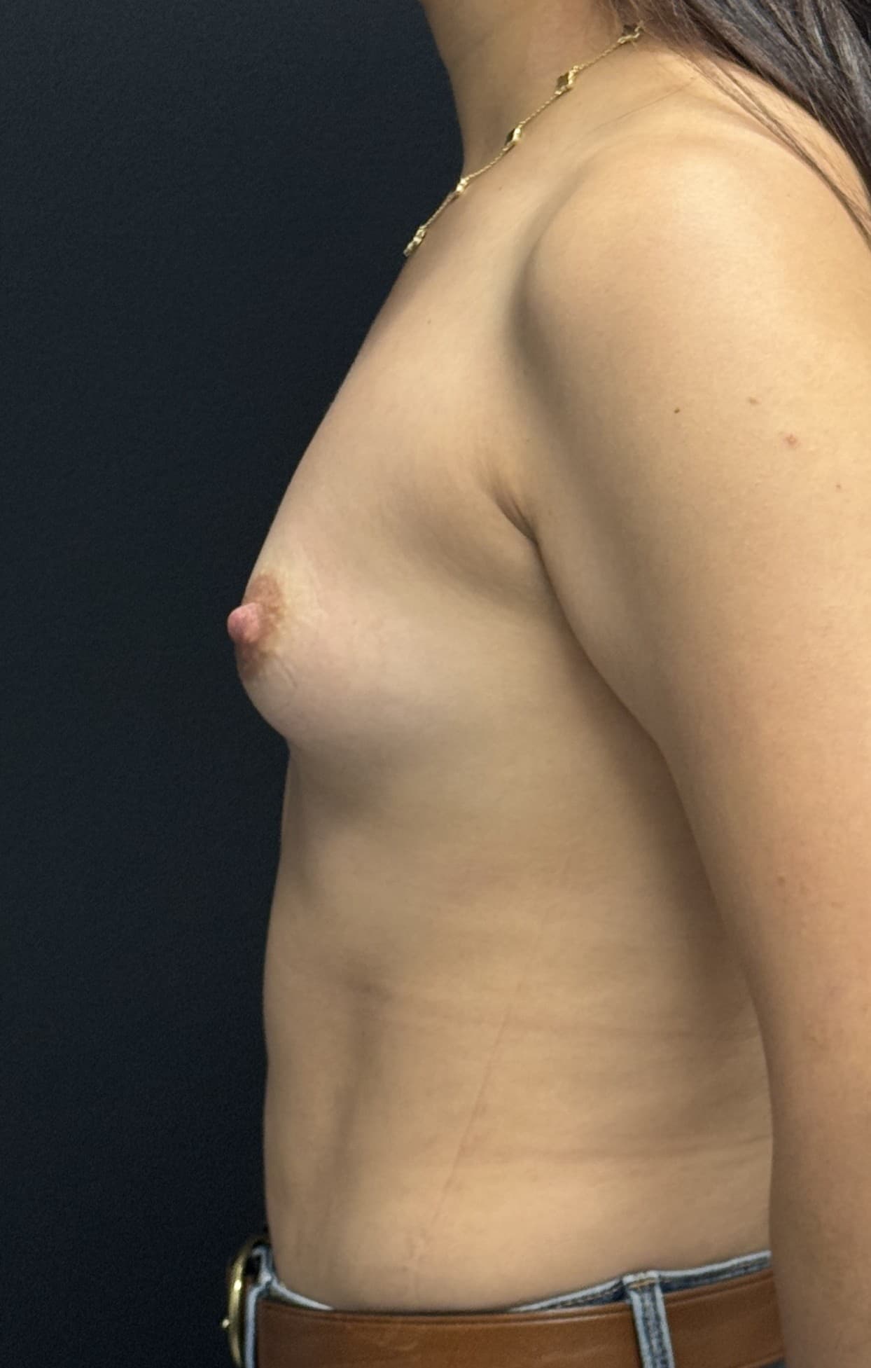 Breast Augmentation Before - Patient 5427 - Left View