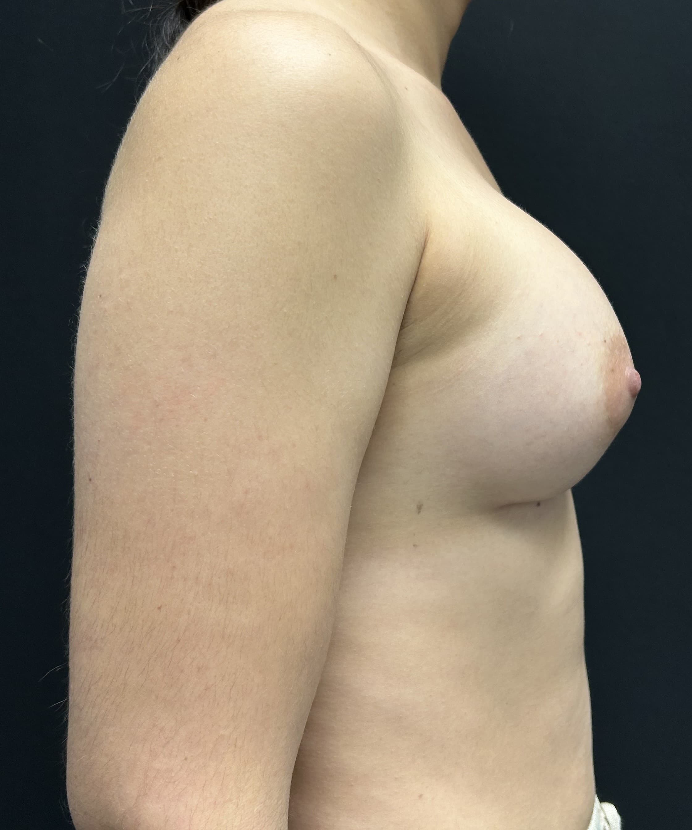 Breast Augmentation After - Patient 5427 - Right View