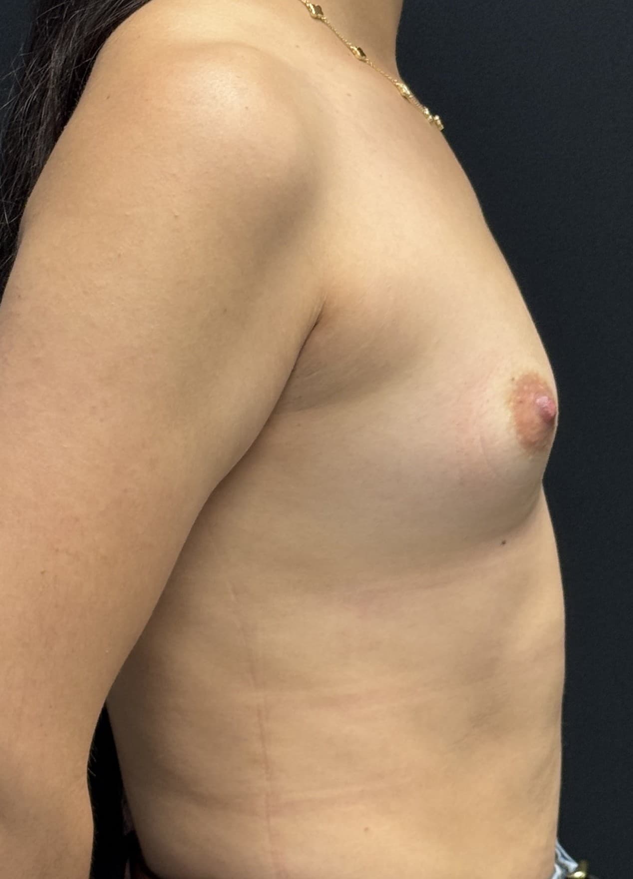 Breast Augmentation Before - Patient 5427 - Right View