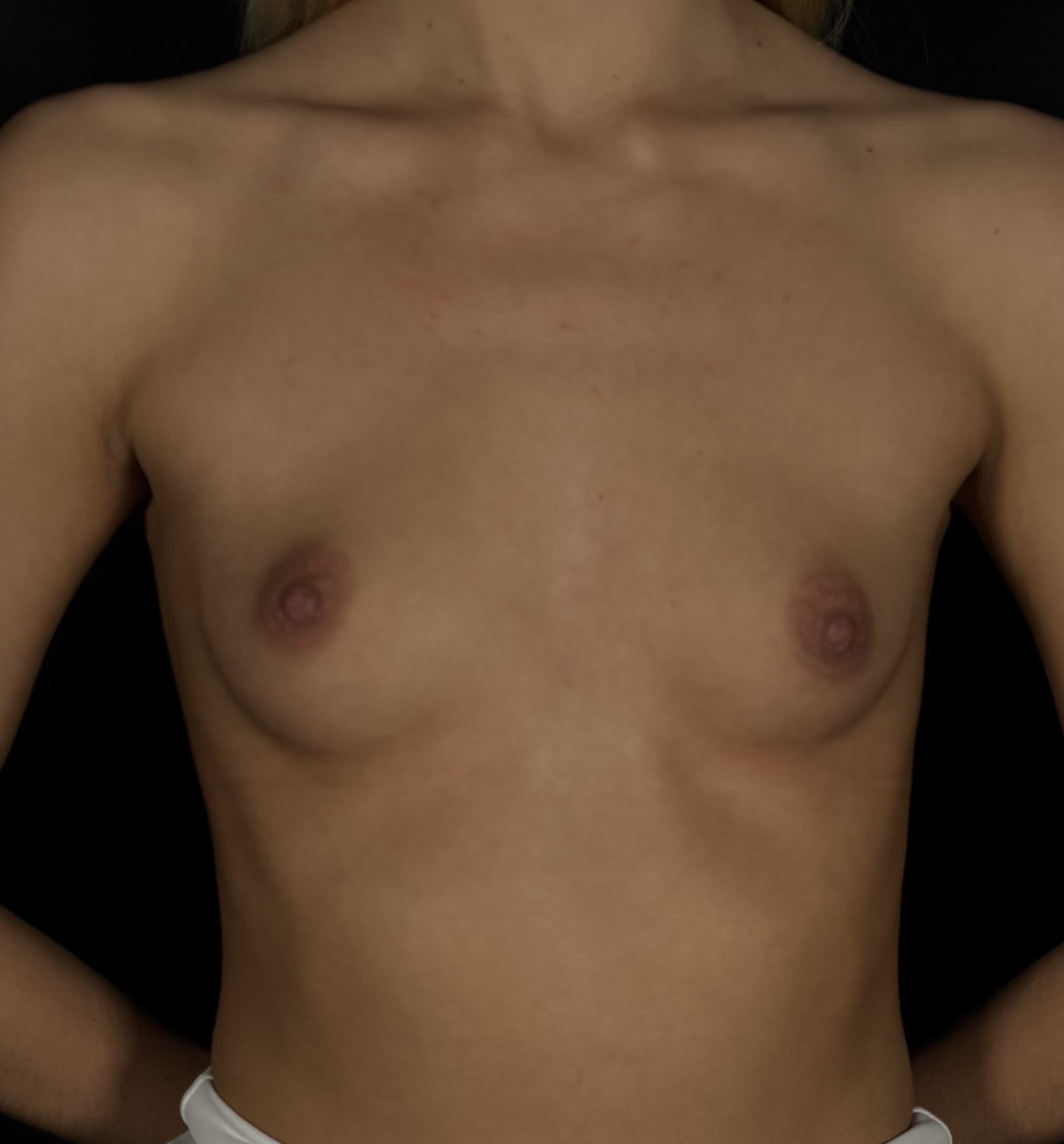 Breast Augmentation Before - Patient 5786