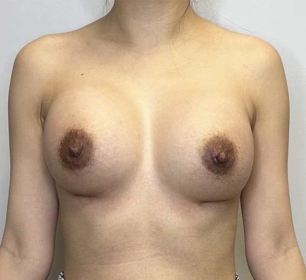 Breast Augmentation After - Patient 93898736 - Front View