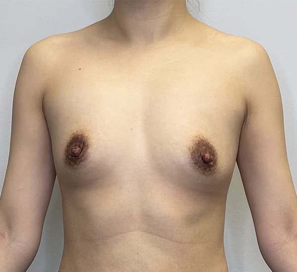 Breast Augmentation Before - Patient 93898736 - Front View
