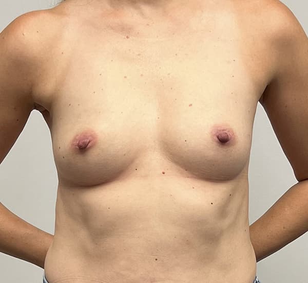 Breast Augmentation Before - Patient 93898788 - Front View