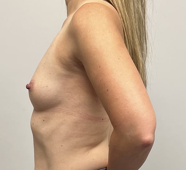 Breast Augmentation Before - Patient 93898788 - Left View