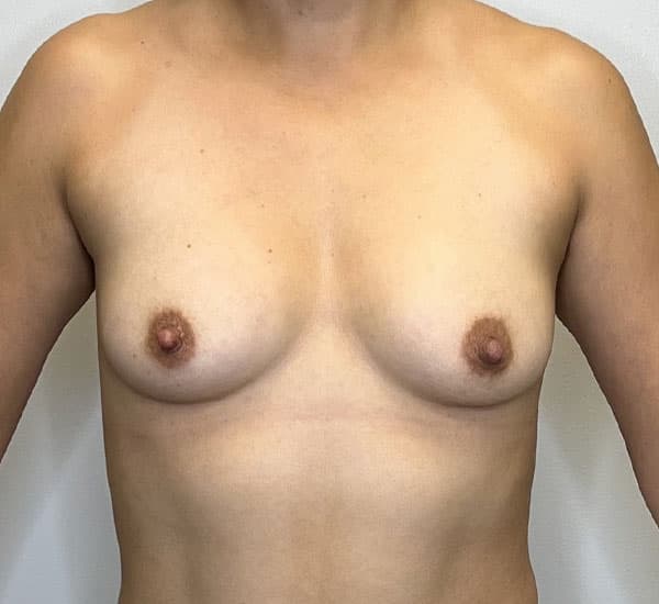 Breast Augmentation Before - Patient 93898844 - Front View