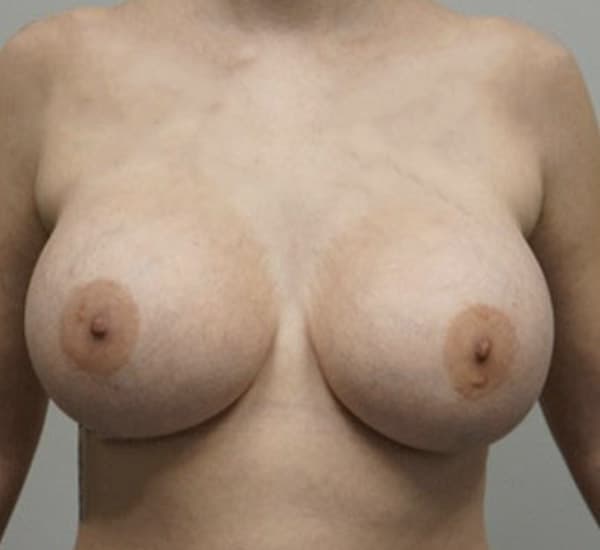 Breast Augmentation After - Patient 93899231 - Front View