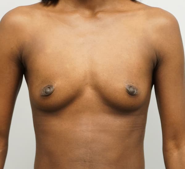 Breast Augmentation Before - Patient 93899233 - Front View