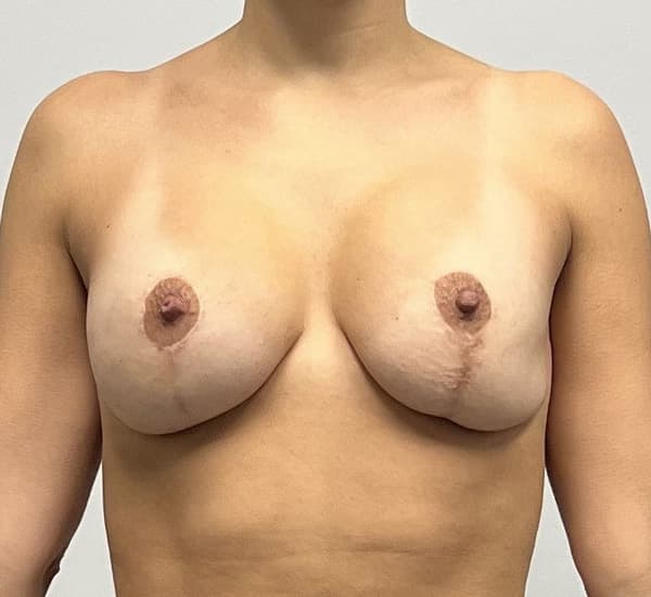 Breast Revision Before - Patient 120258 - Front View