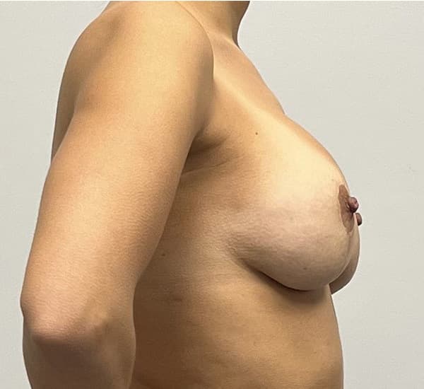 Breast Revision Before - Patient 120258 - Right View