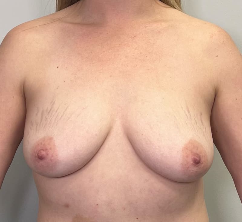 Breast Lift Before - Patient 240189 - Front View