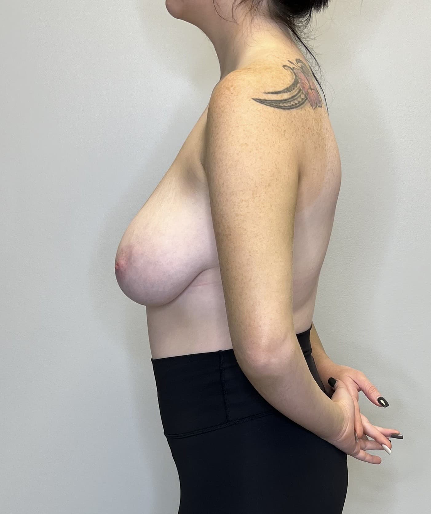 Breast Lift Before - Patient 3172 - Left View
