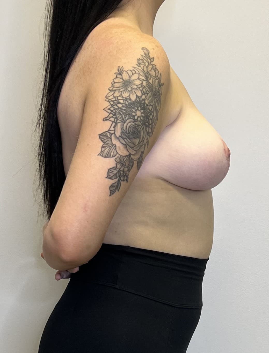 Breast Lift After - Patient 3172 - Right View