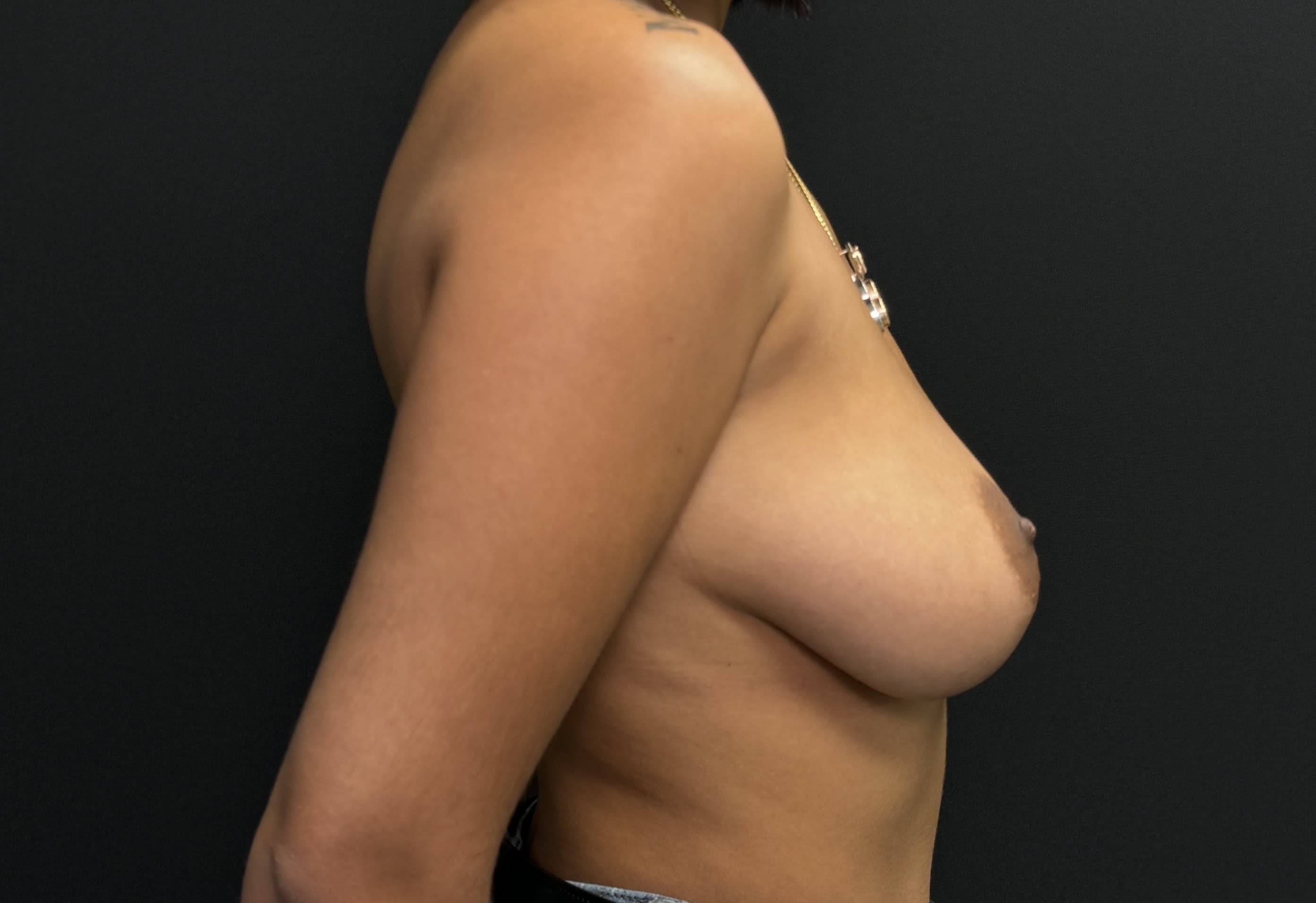 Breast Lift Before - Patient 4268 - Right View