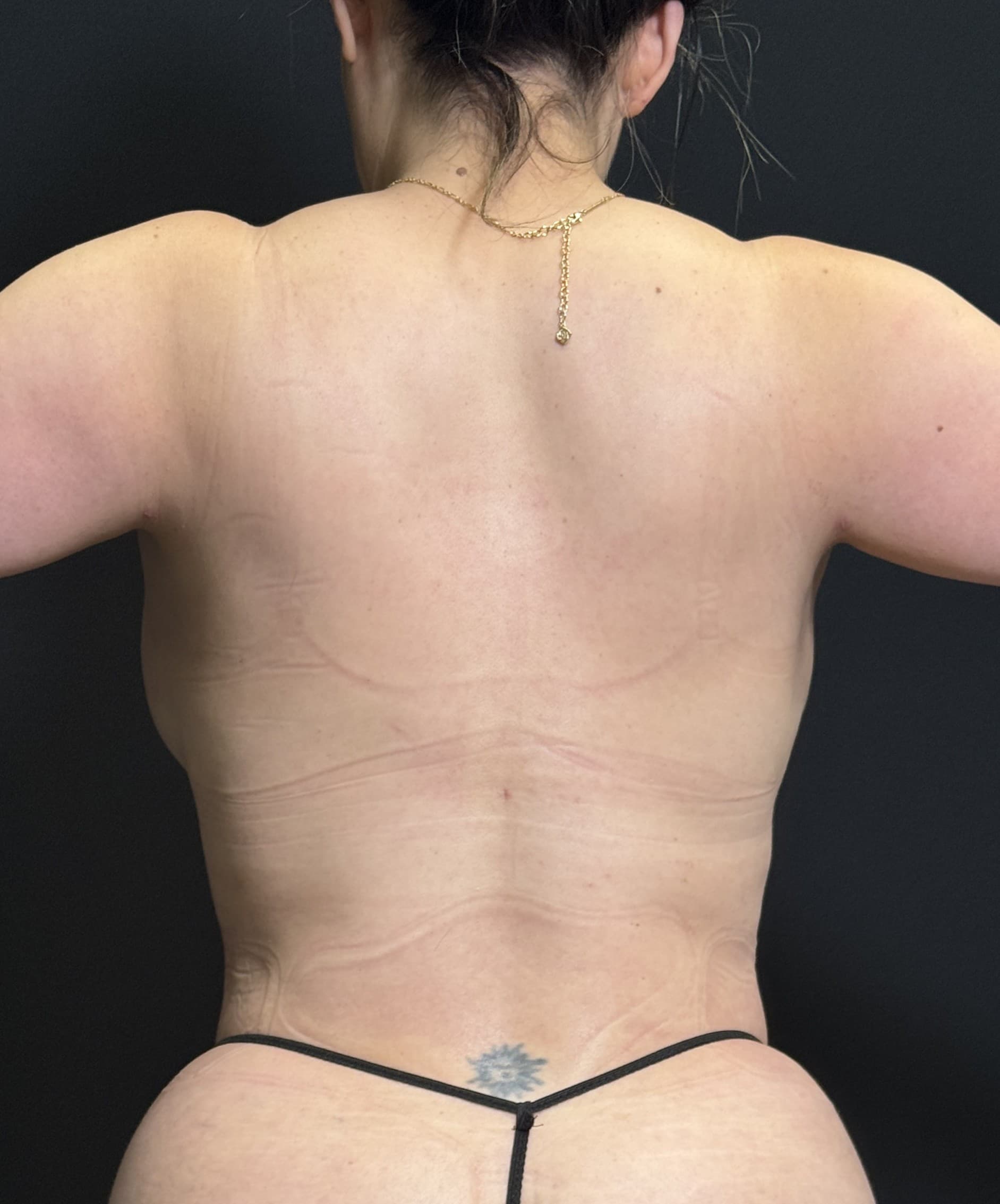 High-Definition Liposuction 360 After - Patient 4853 - Back View