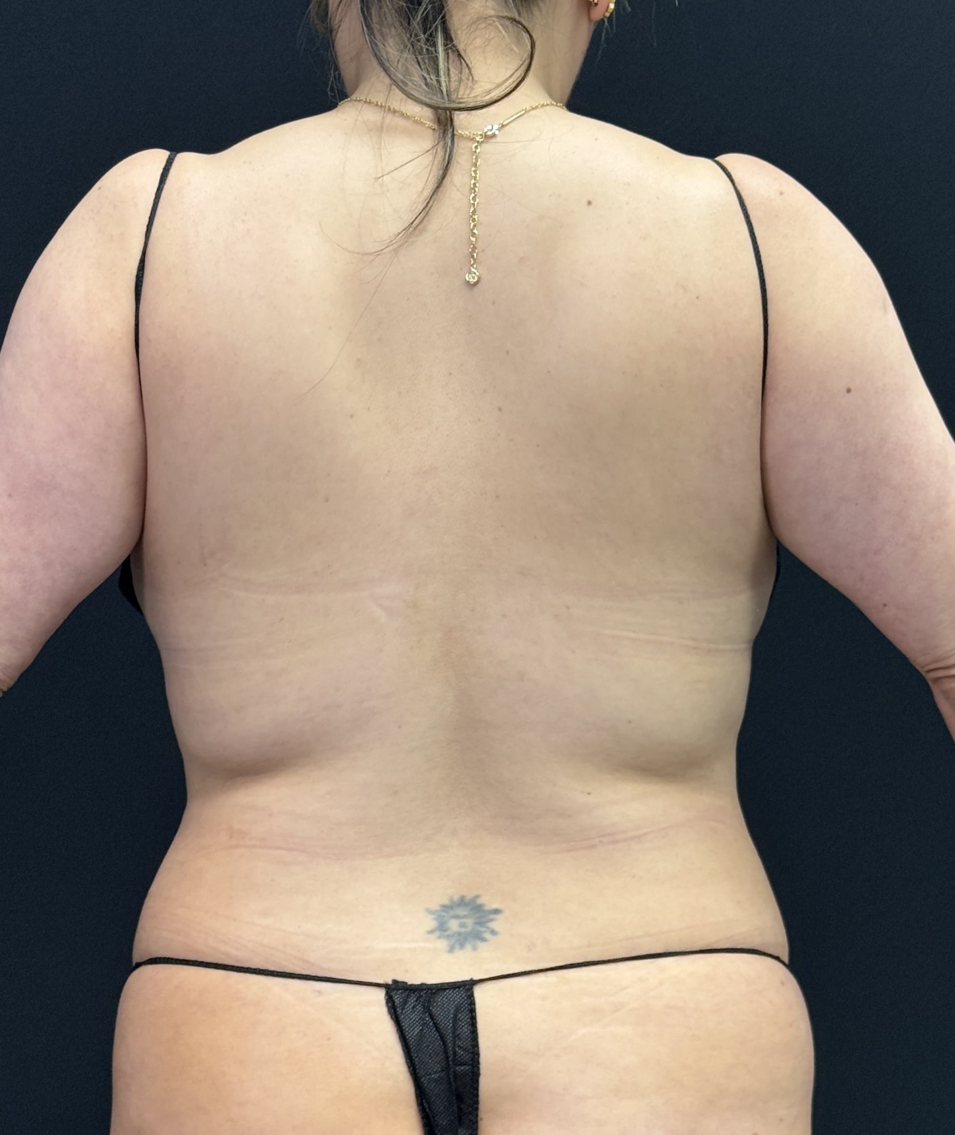 High-Definition Liposuction 360 Before - Patient 4853 - Back View