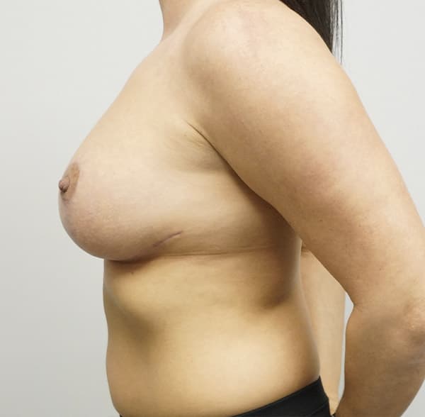 Breast Lift After - Patient 93879151 - Left View