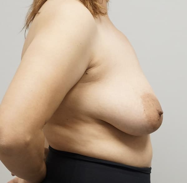 Breast Lift Before - Patient 93879181 - Right View