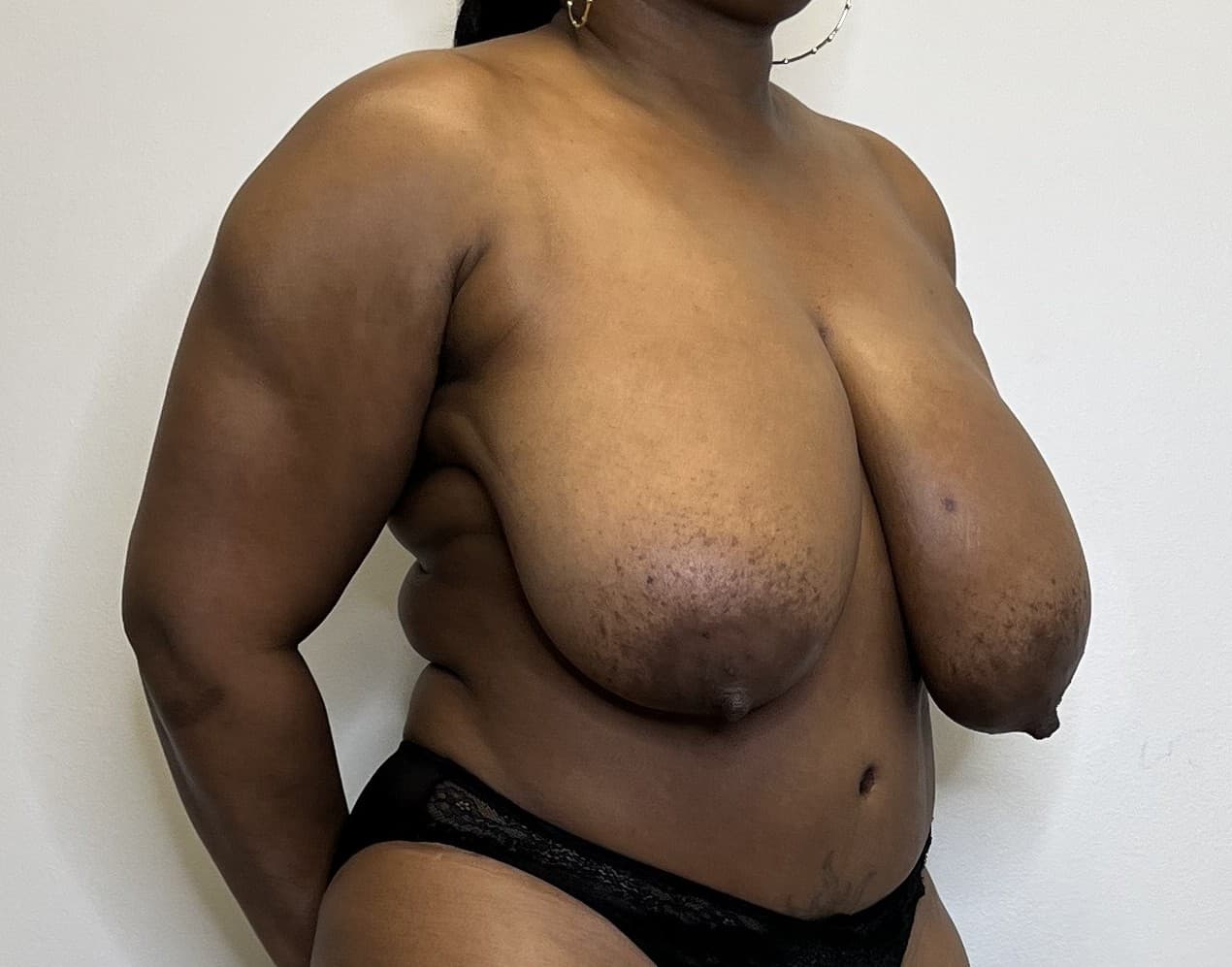 Breast Reduction Before - Patient 3378 - Front Right View