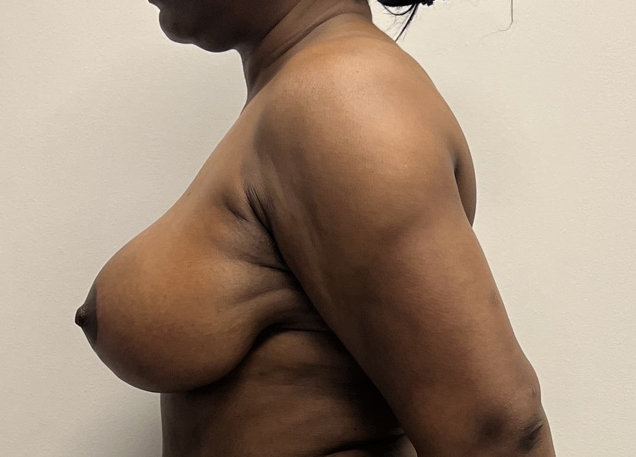 Breast Reduction After - Patient 3378 - Left View