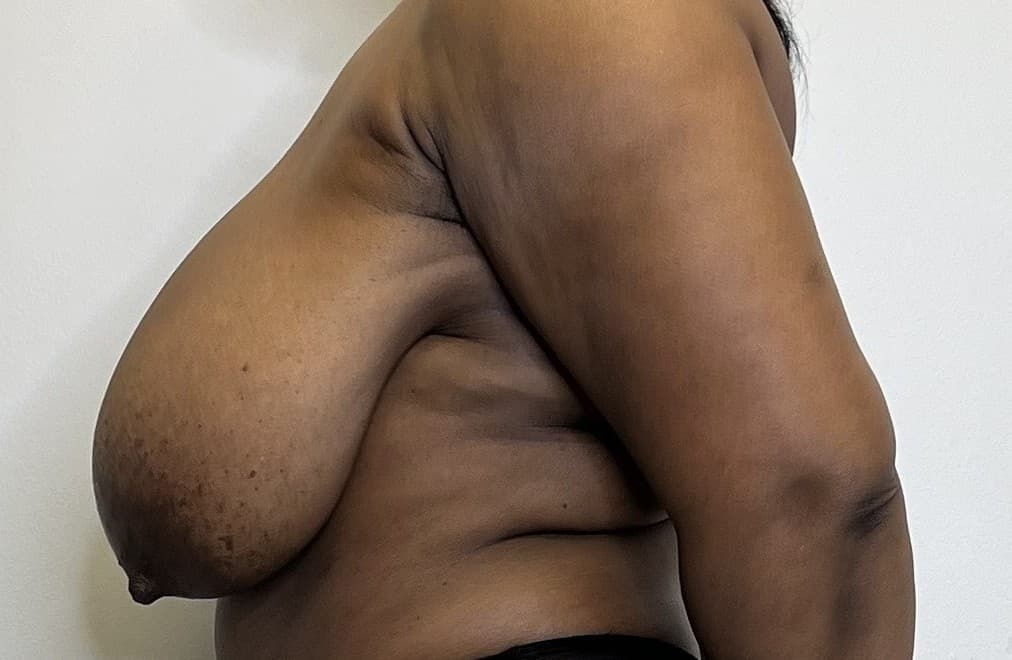 Breast Reduction Before - Patient 3378 - Left View