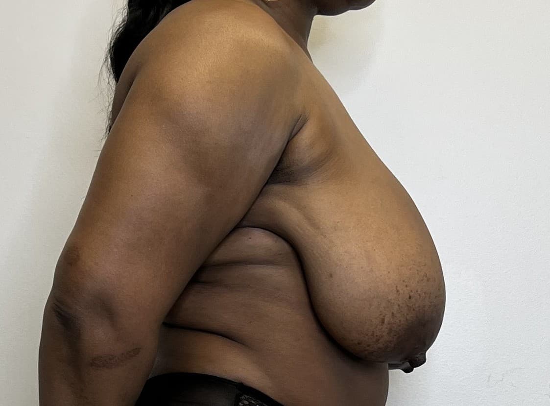 Breast Reduction Before - Patient 3378 - Right View