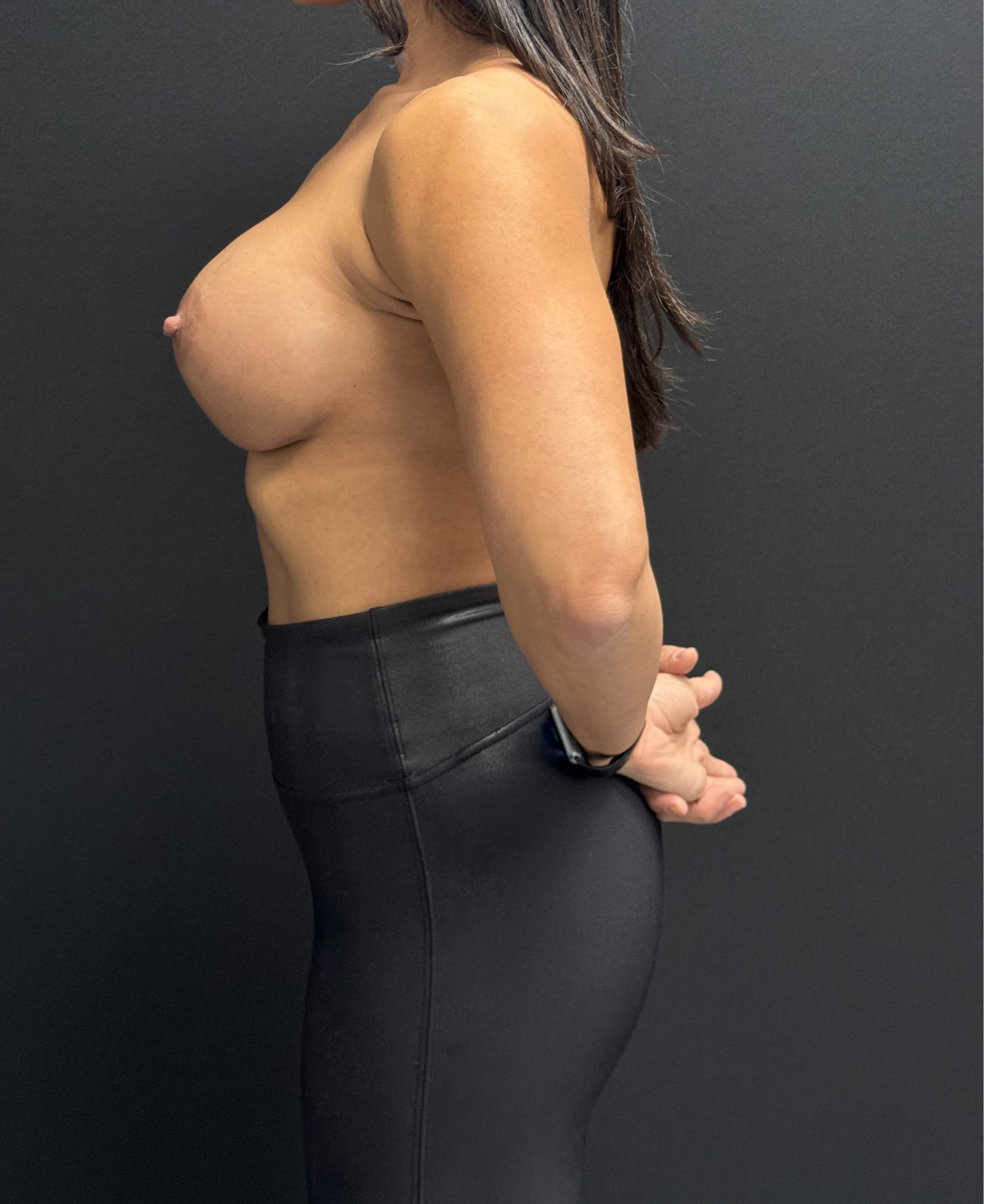 Breast Revision After - Patient 4618 - Left View