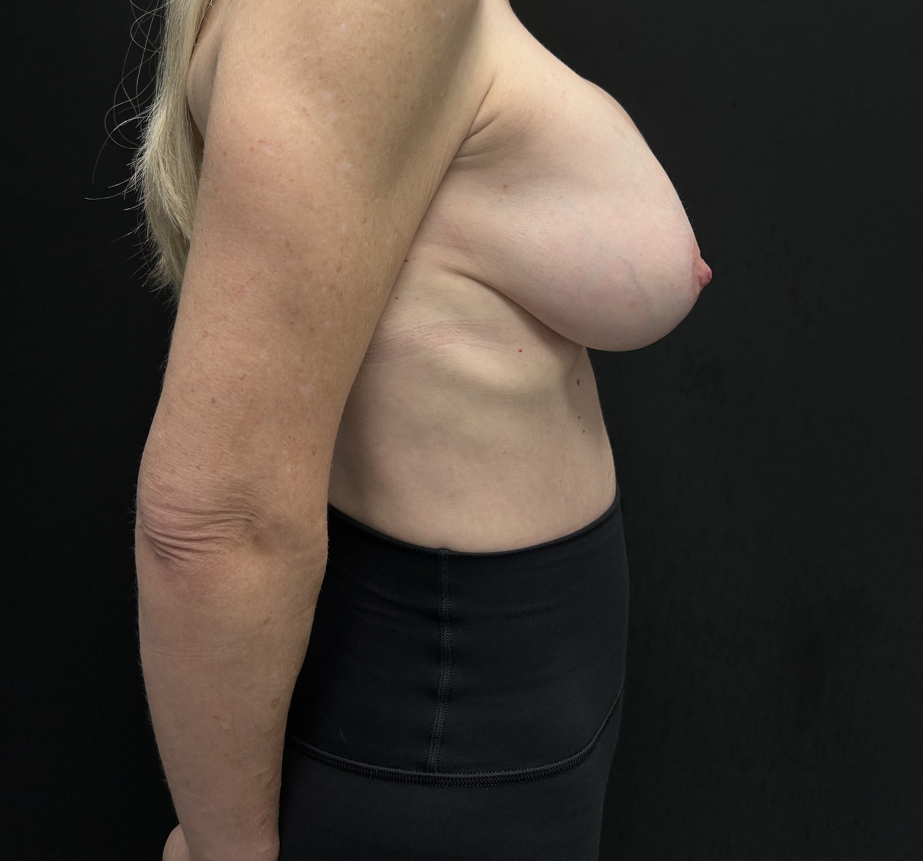 Breast Revision Before - Patient 5905 - Front Left View
