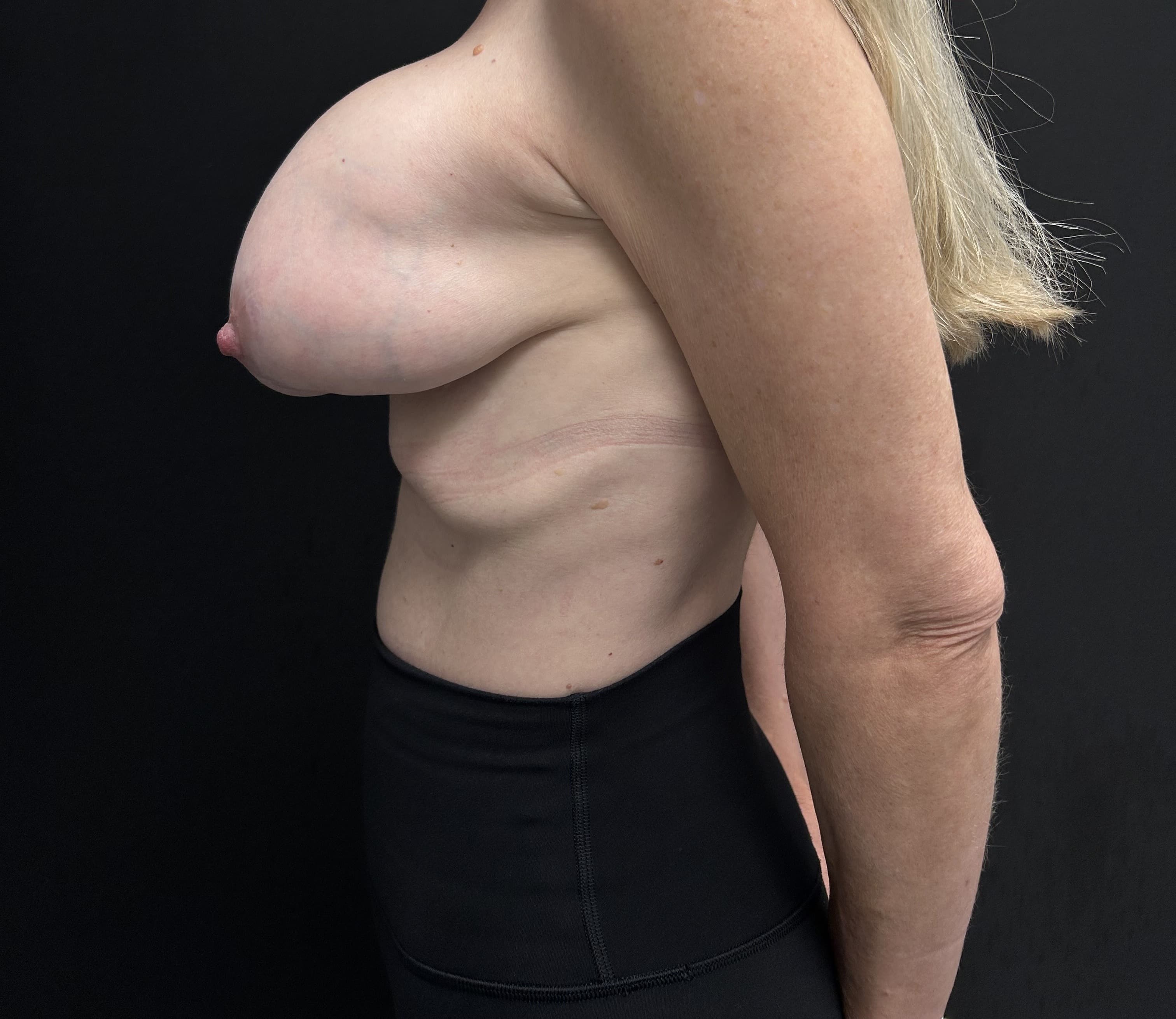 Breast Revision Before - Patient 5905 - Left View