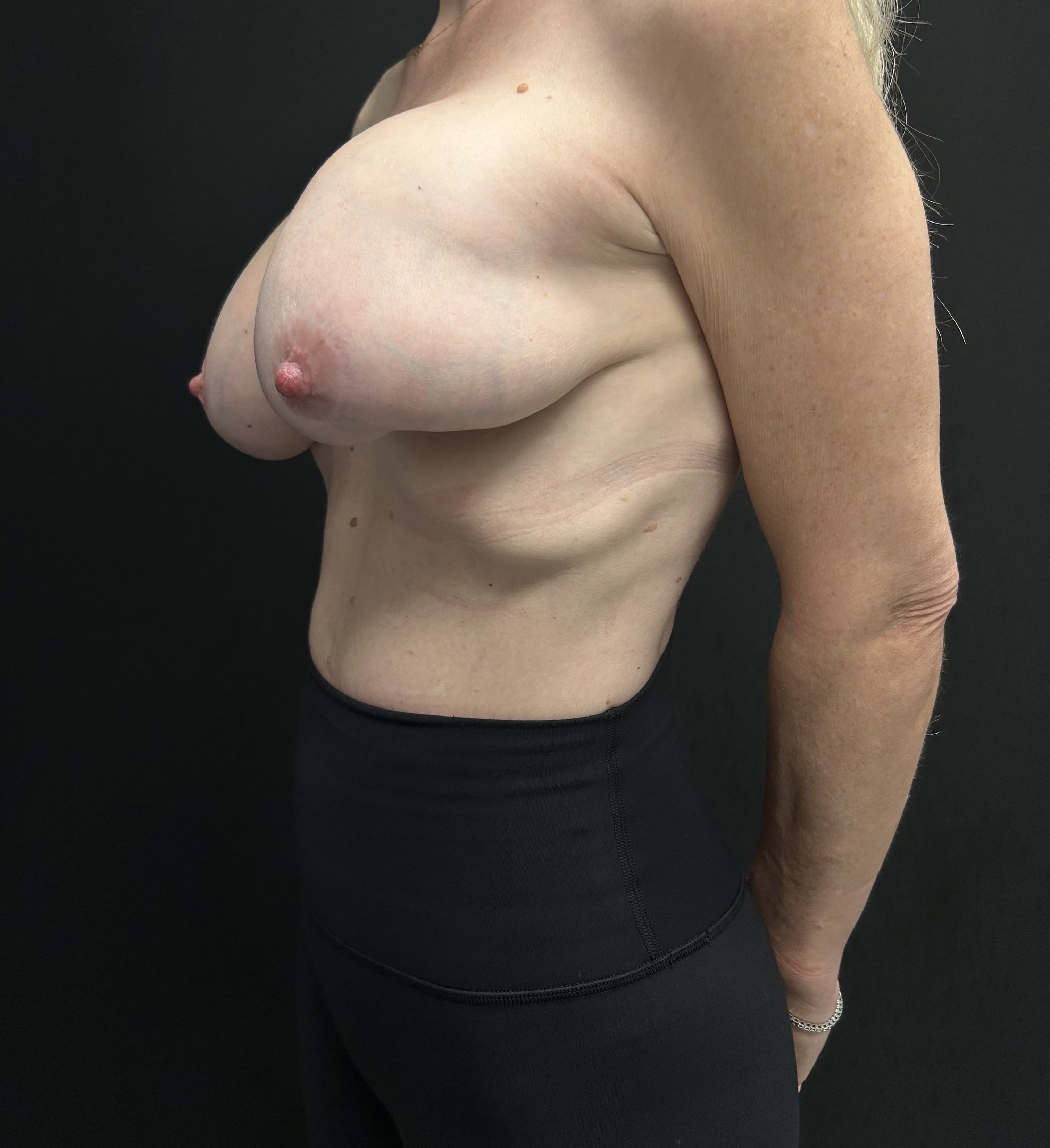 Breast Revision Before - Patient 5905 - Right View