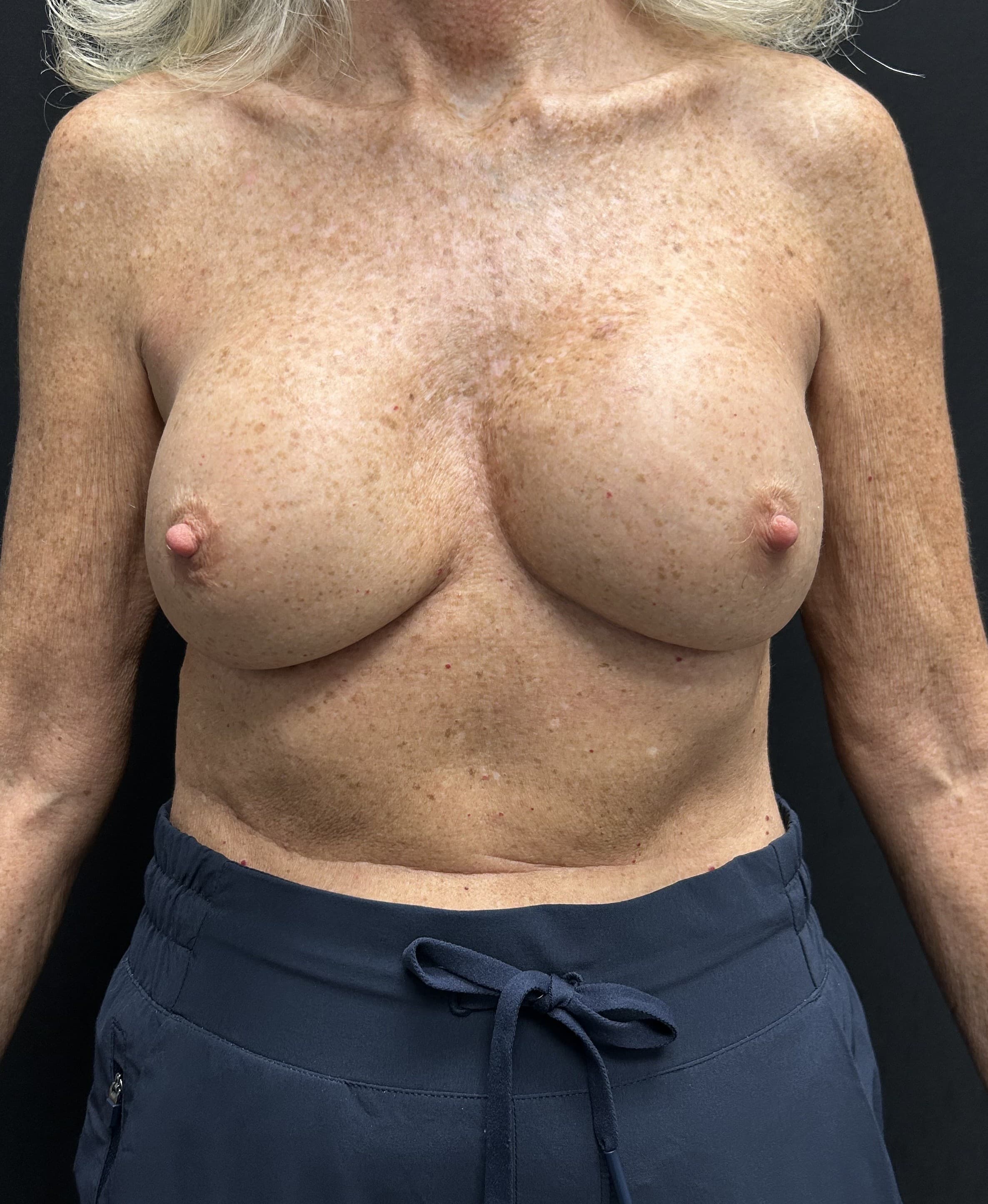 Breast Revision Before - Patient 5918