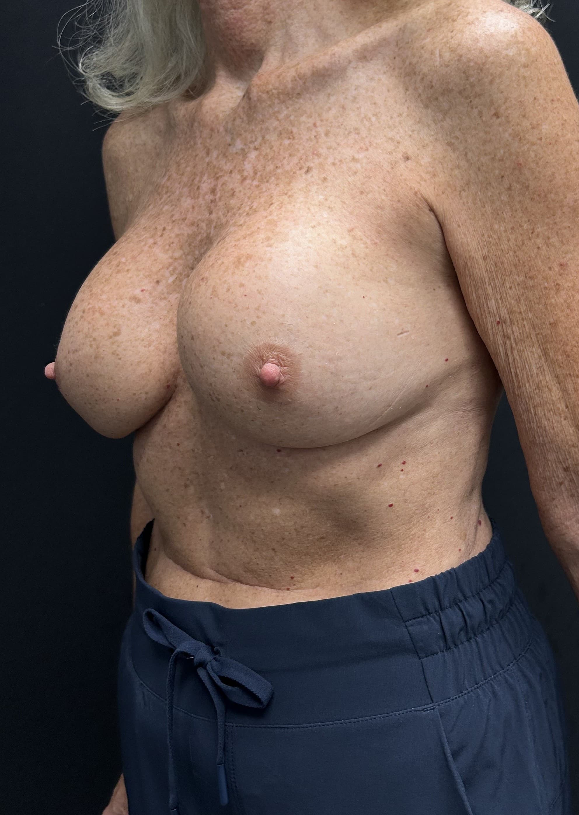 Breast Revision Before - Patient 5918 - Front Left View