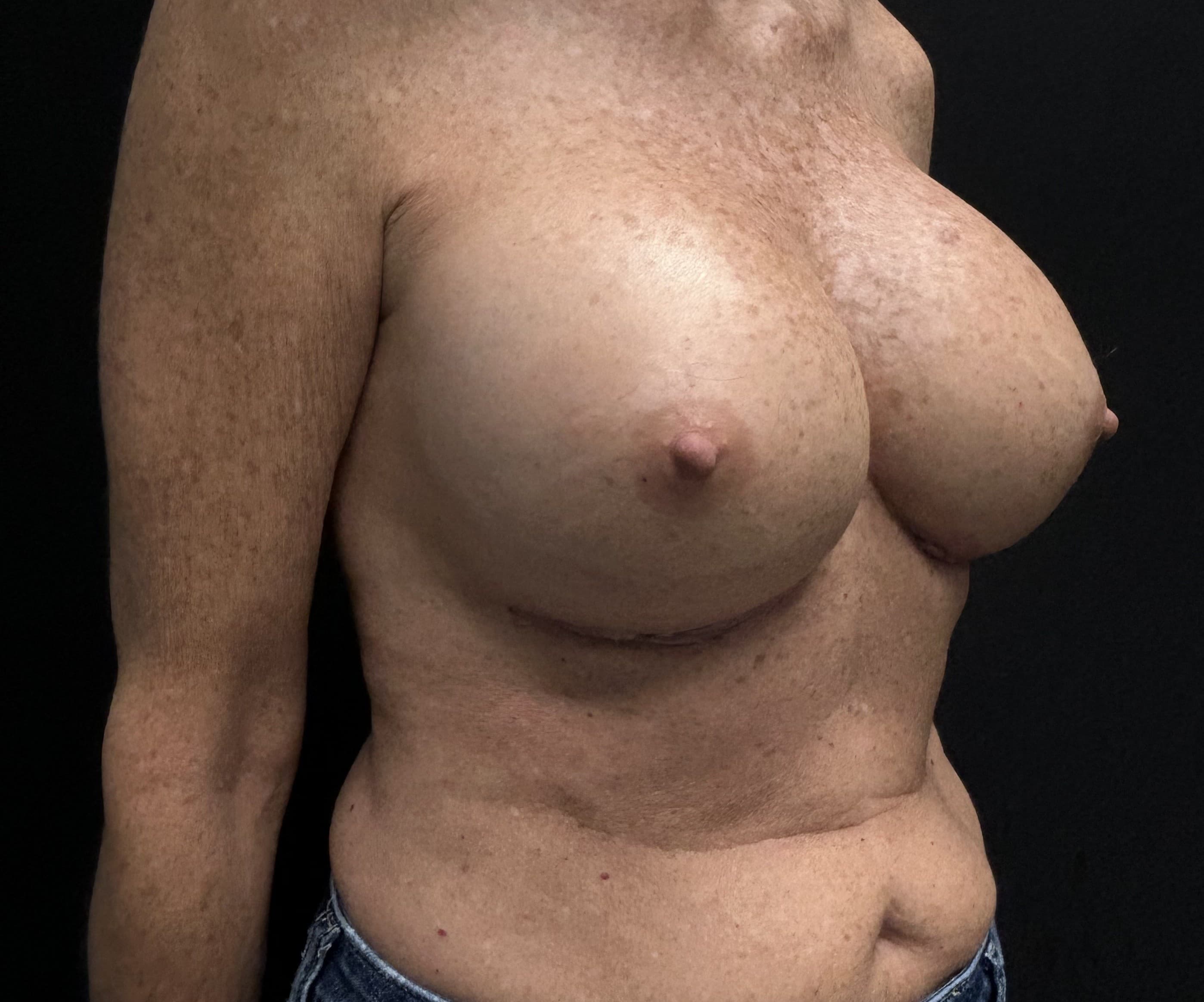 Breast Revision After - Patient 5918 - Front Right View