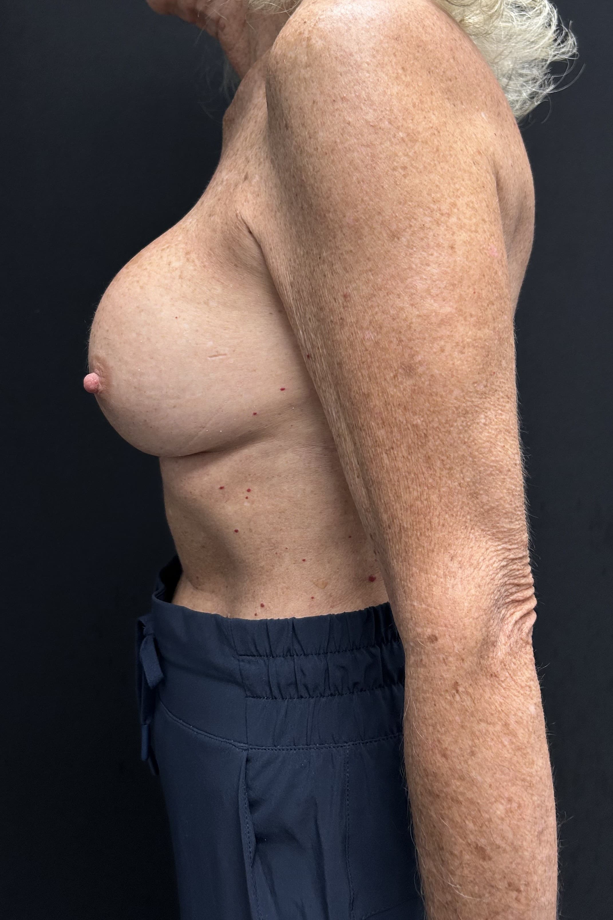 Breast Revision Before - Patient 5918 - Left View
