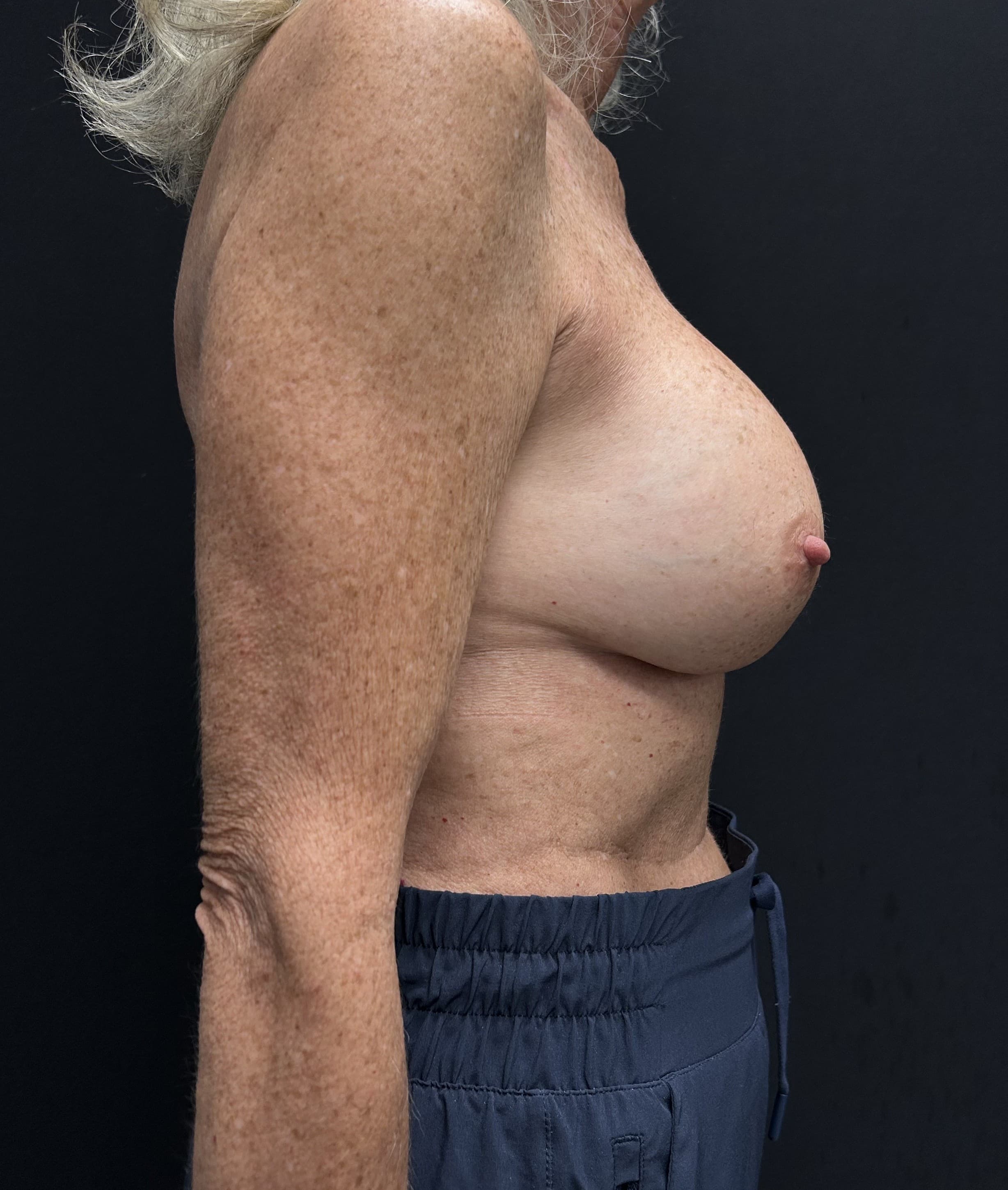 Breast Revision Before - Patient 5918 - Right View