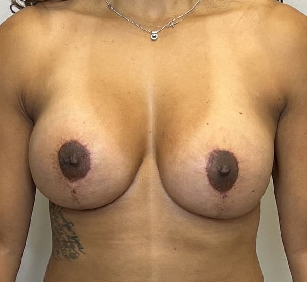Breast Revision After - Patient 93887957 - Front View